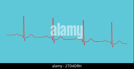 Ventrikuläre Repolarisation, Herzzyklus, EKG des Herzens bei normalem Sinusrhythmus, QT-Intervall des EKGs. Stock Vektor