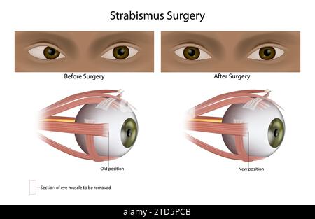 Strabismus oder Schieloperationen behandeln falsch ausgerichtete Augen. Augenmuskelchirurgie. Stock Vektor