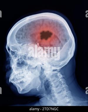 MRT-Scan Gehirn zeigt Ergebnis Hirnkrebs, Hirnabszess. Stockfoto