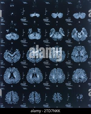Röntgenbild des Patientengehirns mittels Computertomographie für die medizinische Diagnostik. Stockfoto