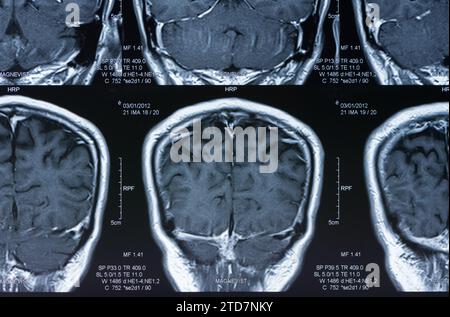 Magnetresonanzbild, mrt-Untersuchung des Gehirns. Stockfoto