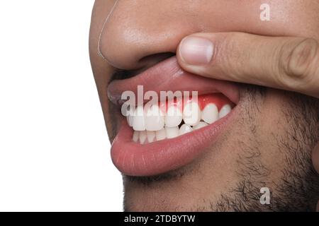 Mann mit entzündetem Kaugummi auf weißem Hintergrund, Nahaufnahme Stockfoto