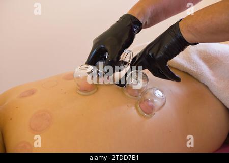 Traditionelle chinesische Schröpftherapie am Rücken von Naturopath. Chinesischer Pokal. Naturheilkunde, Massagen, alternative Medizin, Naturheilkunde. Stockfoto