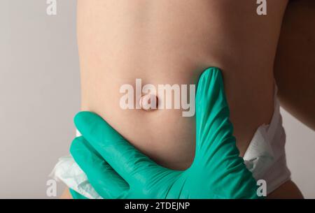 Ein Arzt in medizinischen Handschuhen untersucht den Bauch eines neugeborenen Babys mit einem vergrößerten Nabelring und einer Nabelhernie, Nahaufnahme. Stockfoto