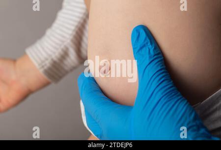 Ein Arzt in medizinischen Handschuhen untersucht den Bauch eines neugeborenen Babys mit einem vergrößerten Nabelring und einer Nabelhernie, Nahaufnahme. Stockfoto