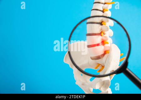 Modell der Lendenwirbelsäule mit roter Zwischenwirbelhernie und Protrusion auf blauem Hintergrund unter Lupe. Das Konzept der Osteochodrose und Stockfoto