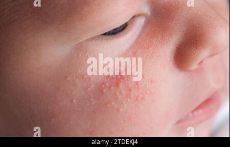 Allergische Pickel bei einem Neugeborenen im Gesicht. Pathogenese, Akne des Neugeborenen, Nahaufnahme Stockfoto