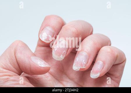 Schuppige gebissene und brüchige Nägel ohne Maniküre. Nachwachsende Nagelkutikula und beschädigte Nagelplatte nach Gelpolitur. Stockfoto