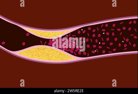Closeup der Atherosklerose. Cholesterin in den Gefässen und erhöhter Blutdruck. Stock Vektor