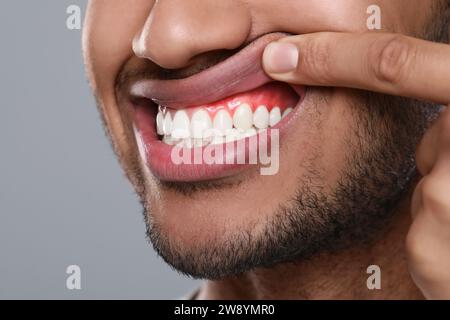 Mann mit entzündetem Kaugummi auf grauem Hintergrund, Nahaufnahme Stockfoto