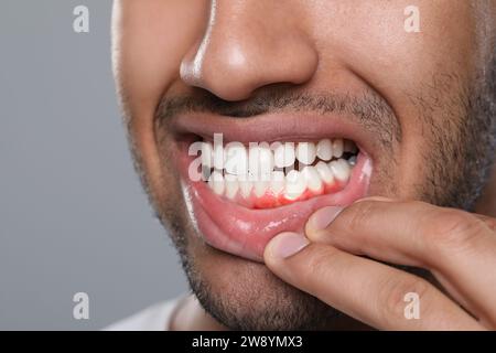 Mann mit entzündetem Kaugummi auf grauem Hintergrund, Nahaufnahme Stockfoto