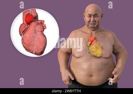 Adipöser Mann mit Aortenaneurysma ascendens, Illustration Stockfoto