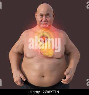 Adipöser Mann mit Aortenaneurysma ascendens, Illustration Stockfoto