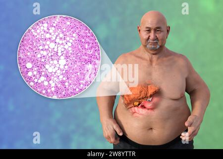 Übergewichtiger Mann mit Lebersteatose, Illustration Stockfoto