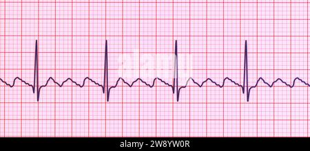 Vorhofflattern abnormer Herzschlag-Rhythmus, Illustration Stockfoto