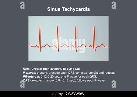 Sinustachykardie Herzrhythmus, Illustration Stockfoto