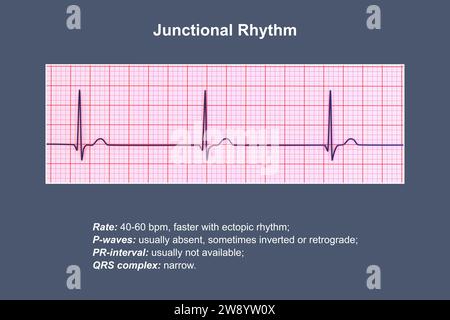 Abbildung eines Elektrokardiogramms (EKG), das einen junktionalen