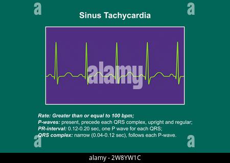 Sinustachykardie Herzrhythmus, Illustration Stockfoto