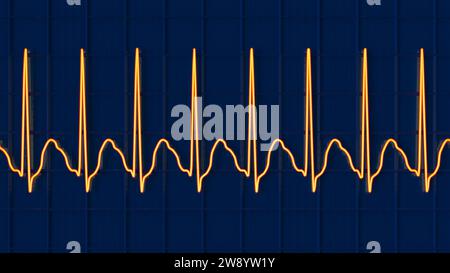 Abbildung Eines Elektrokardiogramms (EKG) Mit Supraventrikulärer ...