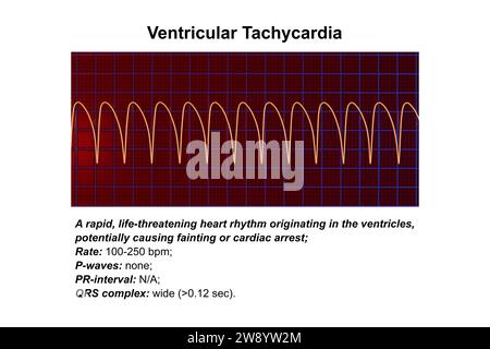 Ventrikuläre Tachykardie Herzschlagrhythmus, Illustration Stockfoto