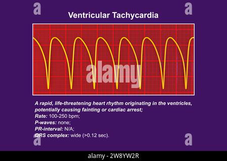 Ventrikuläre Tachykardie Herzschlagrhythmus, Illustration Stockfoto