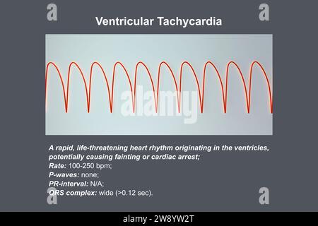 Ventrikuläre Tachykardie Herzschlagrhythmus, Illustration Stockfoto