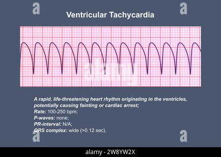 Ventrikuläre Tachykardie Herzschlagrhythmus, Illustration Stockfoto