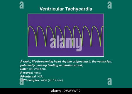 Ventrikuläre Tachykardie Herzschlagrhythmus, Illustration Stockfoto