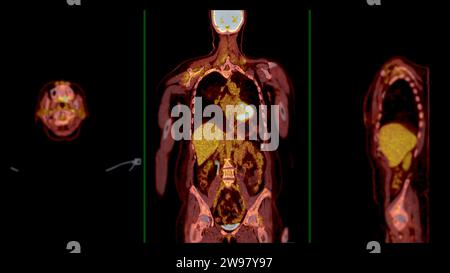 PET CT-Scan-Fusion-Bild es liefert detaillierte Bilder, indem die ...