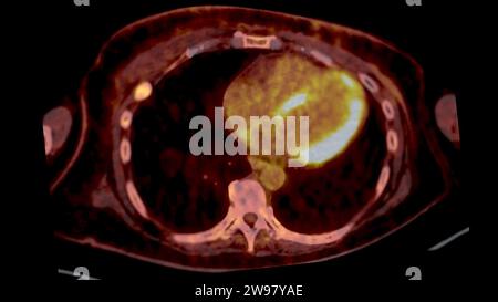 PET CT-Scan-Fusion-Bild es liefert detaillierte Bilder, indem die ...