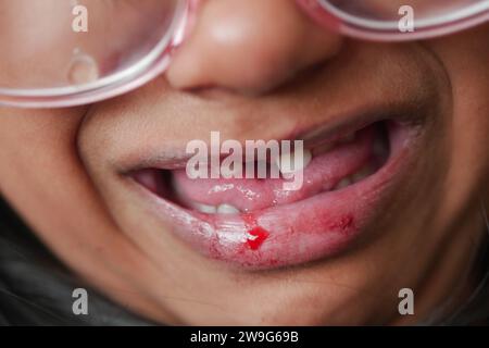 Nahaufnahme der trockenen Lippe eines Kindes Stockfoto