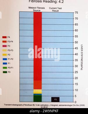 Kairo, Ägypten, 7. November 2023: FibroScan-Untersuchung der Leber ergab F0 für Lebersteifigkeit, S0 für Lebersteatose, Fibrose 4,2 Stockfoto