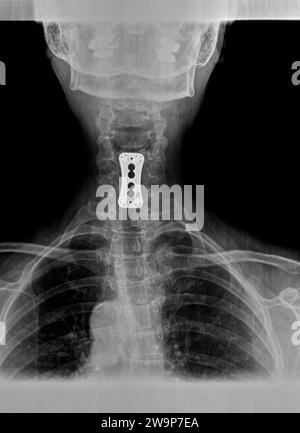 Filmröntgenaufnahme oder Röntgenaufnahme des Halshalses. AP-Ansicht anterior posterior mit chirurgischer Halterung zur Stabilisierung des Nackens des Patienten Stockfoto