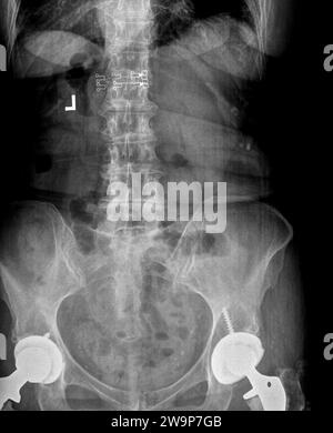Filmröntgenaufnahme oder Röntgenaufnahme der Lendenwirbelsäule, des Beckens und der Hüfte. AP-Ansicht anterior posterior mit beidseitiger Hüftprothese mit Titanschrauben Stockfoto