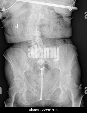 Röntgenaufnahme oder Röntgenaufnahme eines normalen erwachsenen Lendenwirbels anterior posterior AP-Ansicht mit mittelschwerer bis schwerer linksseitiger Konvexitätsskoliose oder S c Stockfoto