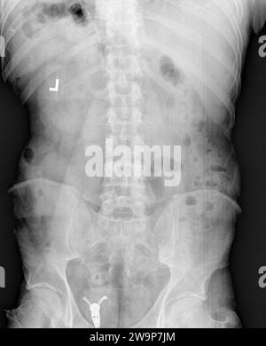 Röntgenbild oder Röntgenaufnahme eines normalen erwachsenen Lendenwirbels anterior posterior AP-Ansicht mit normaler Knochenstruktur Stockfoto