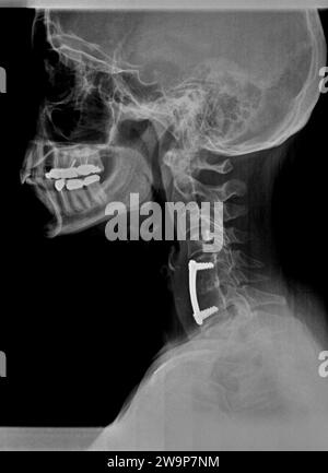 Filmröntgenaufnahme oder Röntgenaufnahme des Halshalses. Seitliche Seitenansicht mit chirurgischer Halterung zur Stabilisierung des Nackens des Patienten Stockfoto