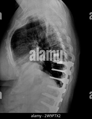 Filmröntgenaufnahme oder Röntgenaufnahme eines mittleren Rückenwirbels. Seitliche Seitenansicht mit chirurgischer Halterung zur Stabilisierung der Patienten im mittleren Rücken Stockfoto