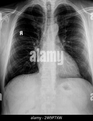 Thoraxröntgenaufnahme von Patienten mit emphysematöser Lunge, hilärer Adenopathie mit Herz-, Wirbel- und Lungengefässen Stockfoto