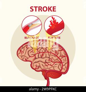 Stroke Day Brain Illustrations Design Stock Vektor