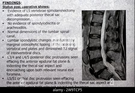 Die lumbosakrale Wirbelsäule zeigt L5-Wirbelsäulenlaminektomie, posteriore Thekalsackdekompression, lumbale Spondylose, posteriore Bandscheibenprotrusio Stockfoto