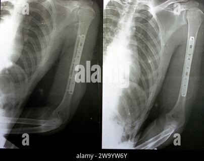 Einfaches Röntgenbild mit linker Oberarmfraktur im Mittelschaft durch direktes Trauma bei einem Autounfall, behandelt durch offene Reposition und innere Fixa Stockfoto