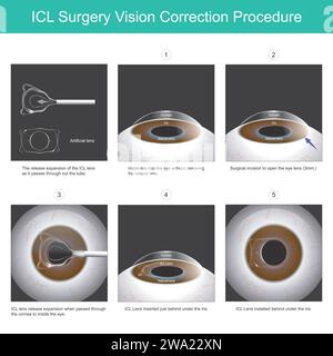 ICL-Chirurgie Sehkorrektur-Verfahren. Eine neue Augenlinse, die in das Auge implantiert werden kann, ohne die natürliche Linse zu entfernen. Stock Vektor