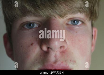 Dublin, Irland - 3. Januar 2024: Ein Foto des Gesichts eines Jungen, das mit Flecken bedeckt ist. Stockfoto