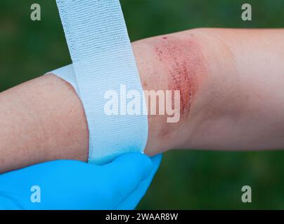 Des Arztes Hand Heilung eine verbrannte Hautstelle Stockfoto