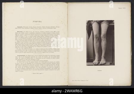 Patient mit der Hautkrankheit 'Purpura', um 1886 - in oder vor 1896 fotomechanischer Druck Amsterdampublisher: Haarlem Papier Kollotyphaut und Geschlechtskrankheiten. Beine Stockfoto