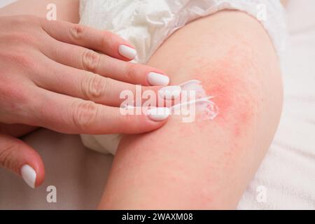 Die Mutter behandelt die Pickel-Allergie ihres Kindes mit einer Creme. Die Frau trägt sanft Creme auf die irritierte Haut des Beines ihres Babys auf. Stockfoto