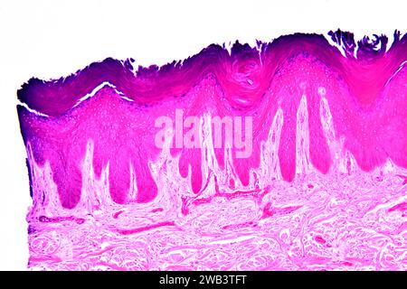 Geschichtete Plattenepithel aus der menschlichen Handhaut, die keratinisierte Epidermis und Dermis mit Bindegewebe zeigt. X 75 bei 10 cm Breite. Stockfoto