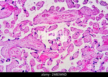 Menschliche Plazenta mit Chorionzotten, Blutgefäßen und roten Blutkörperchen. X 75 bei 10 cm Breite. Stockfoto