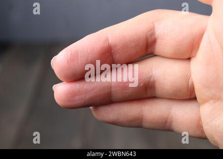 Verletzter Finger. Ein Zeichen einer geheilten Wunde an einem Finger. Narben. Stockfoto